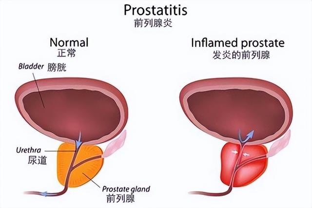 前列腺有什么预防防治的好方法(保护前列腺的4个方法)(1)