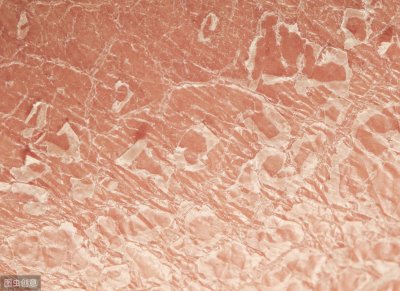 ​皮肤干燥像鱼鳞，是皮肤干燥还是遗传性皮肤病？