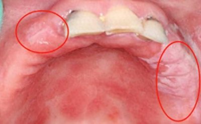 ​佩戴活动假牙必须警惕的五大隐患！
