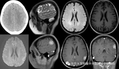 ​“脑膜尾征”你不会只知道脑膜瘤吧？